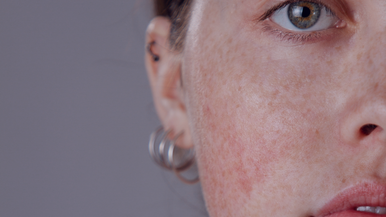 How to Care for Rosacea During the Winter